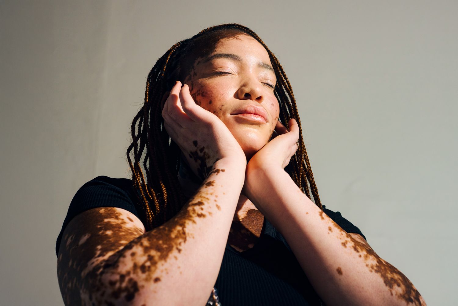 A person with closed eyes hands touching their face vitiligo visible on their arms and face